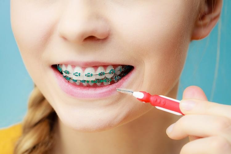 interdental brushes for braces